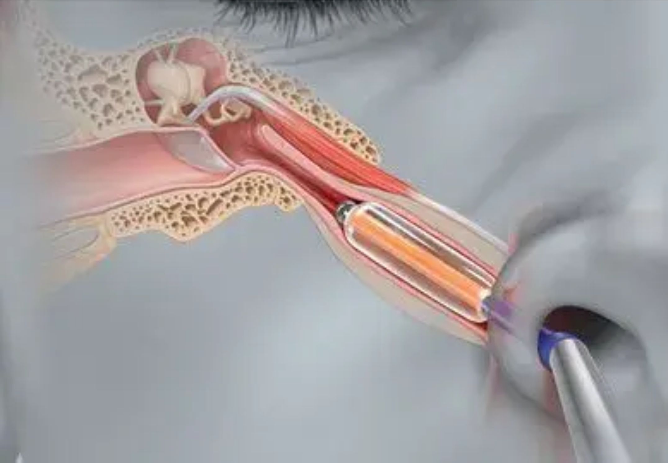 Eustachian Tube Balloon Dilation